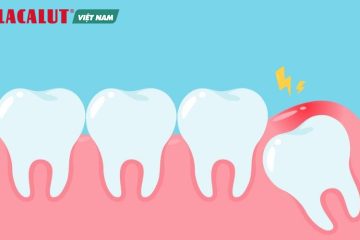 Lợi trùm răng khôn: Nguyên nhân, biểu hiện và cách điều trị