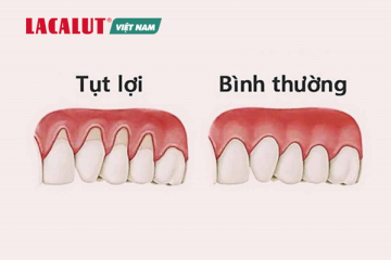 Tụt lợi khi niềng răng. Nguyên nhân và cách khắc phục?