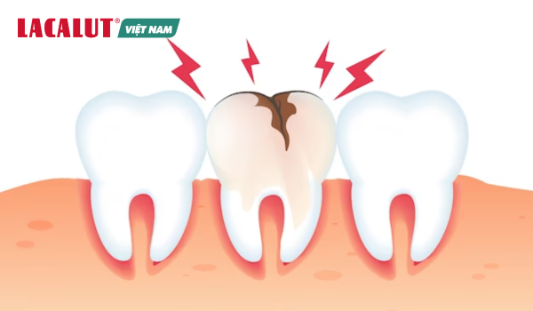 dấu hiệu của sâu răng