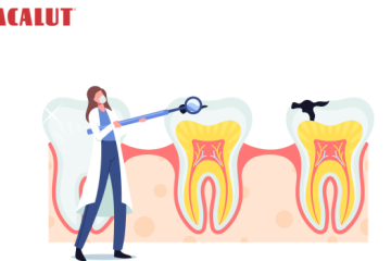 Sâu răng có niềng được không? Những lưu ý cần nhớ